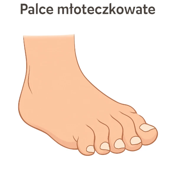 palce mloteczkowate u dzieci